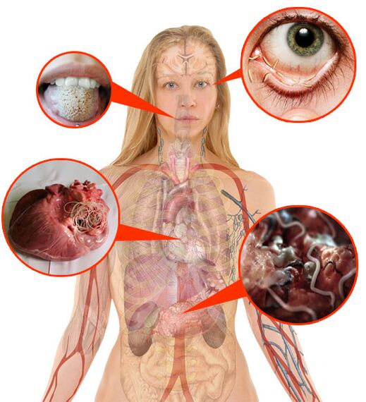 Parasitos e vermes no corpo humano